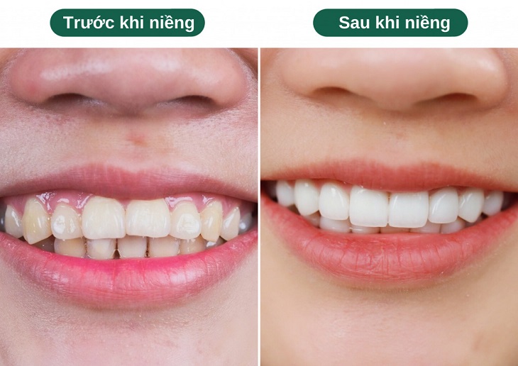 Hình ảnh khách hàng niềng răng Invisalign trước và sau