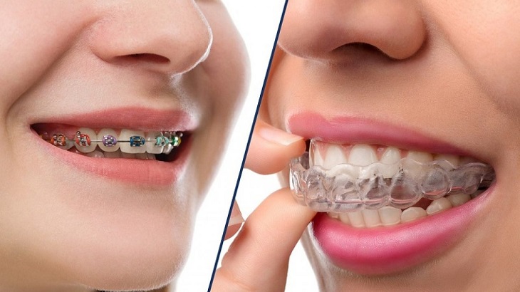 Niềng răng Invisalign là phương pháp chỉnh nha tiên tiến nhất trong thẩm mỹ nha khoa