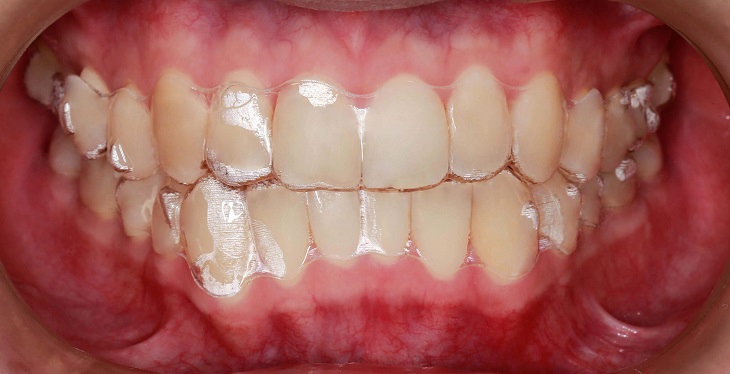 Khi thực hiện niềng răng Invisalign có cần nhổ răng không còn phụ thuộc vào tình trạng mỗi người