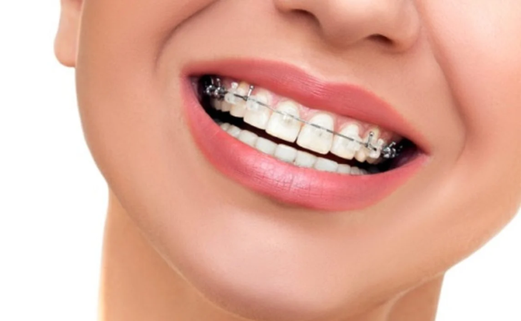 Niềng răng 1 hàm giúp tiết kiệm thời gian, chi phí