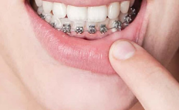 Niềng răng 1 hàm là khái niệm dùng để chỉ phương pháp nắn chỉnh răng hàm trên hoặc hàm dưới