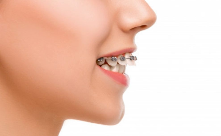 Tình trạng răng miệng càng nghiêm trọng thời gian càng lâu và chi phí càng cao