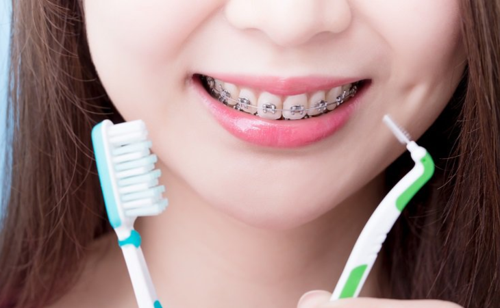 Lưu ý chăm sóc răng miệng khi niềng răng 1 hàm
