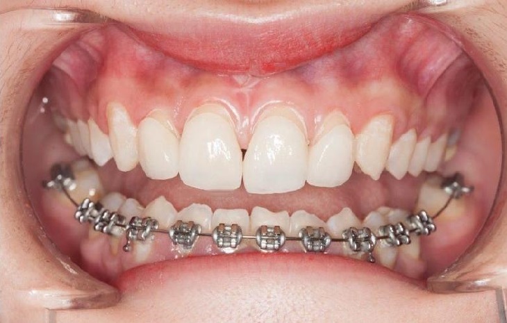 Có nên niềng răng hàm dưới không là câu hỏi được nhiều người quan tâm