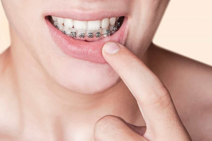Chi phí niềng răng 1 hàm thường bằng 2/3 giá so với niềng răng 2 hàm