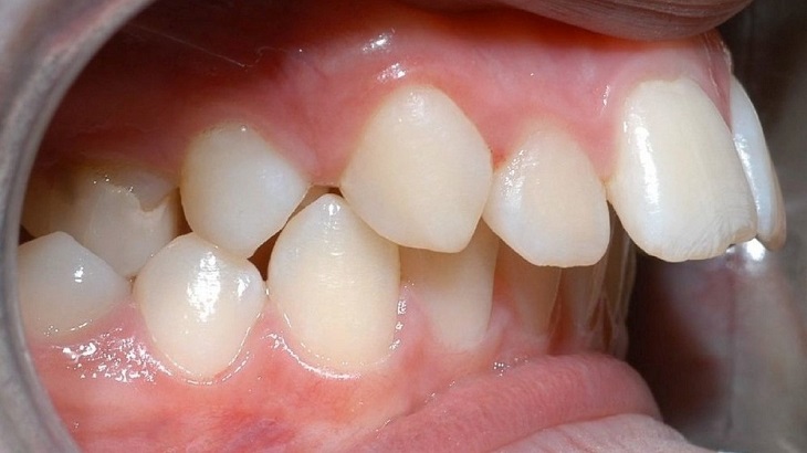 Người bị răng hô thường có hàm răng trên chìa ra ngoài