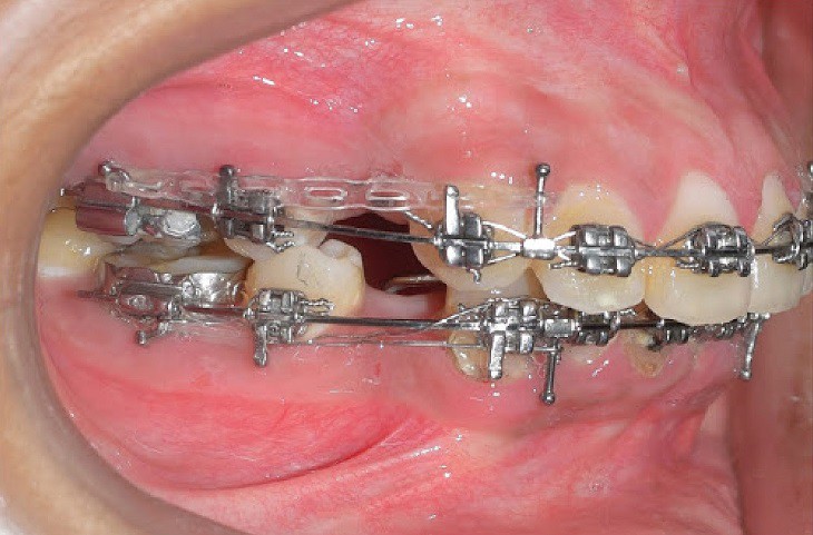 Có rất nhiều khí cụ được sử dụng trong quá trình niềng răng