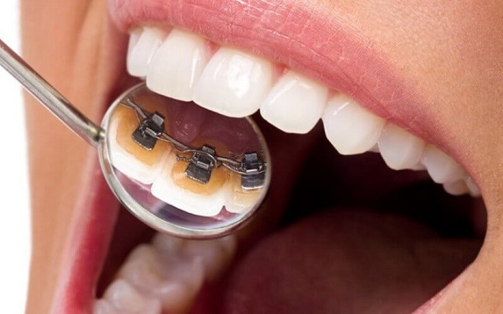 Niềng răng vẩu sử dụng mắc cài kim loại mặt trong