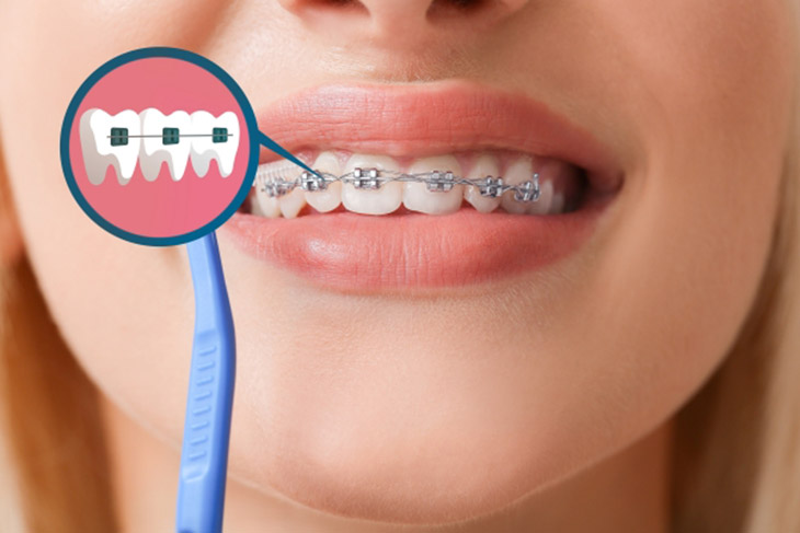 Với tình trạng hô nhẹ, bệnh nhân có thể phải nhổ răng hoặc không