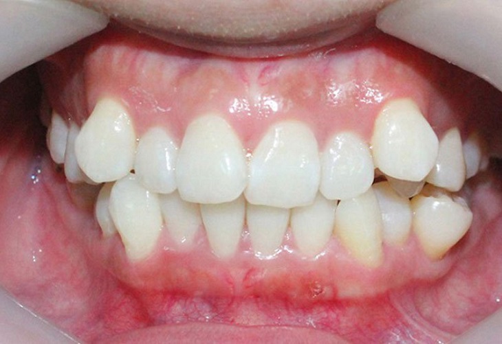 Niềng răng khểnh có nhổ răng không tủy thuộc vào quyết định của bác sĩ