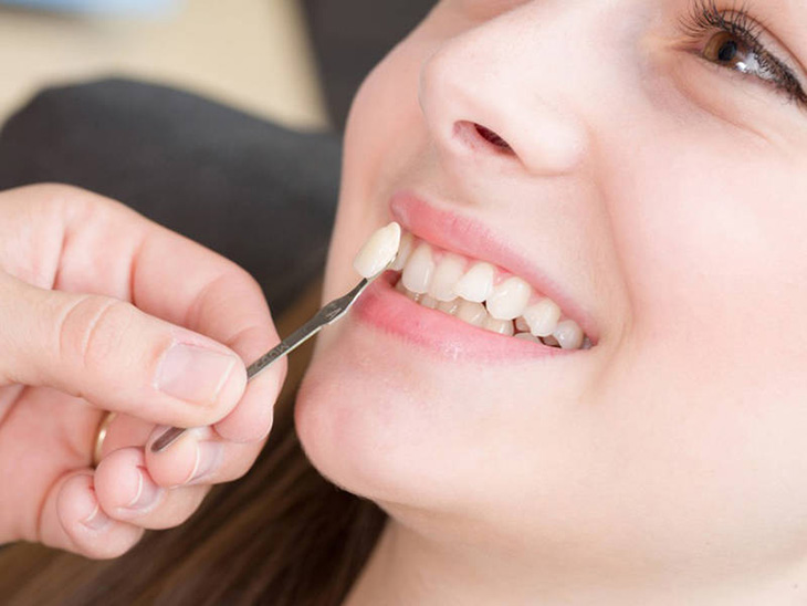 Kỹ thuật chỉnh nha với răng khểnh giúp đem lại nụ cười tự tin
