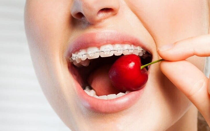 Trong quá trình niềng răng việc xây dựng chế độ ăn uống đúng cách là điều rất quan trọng