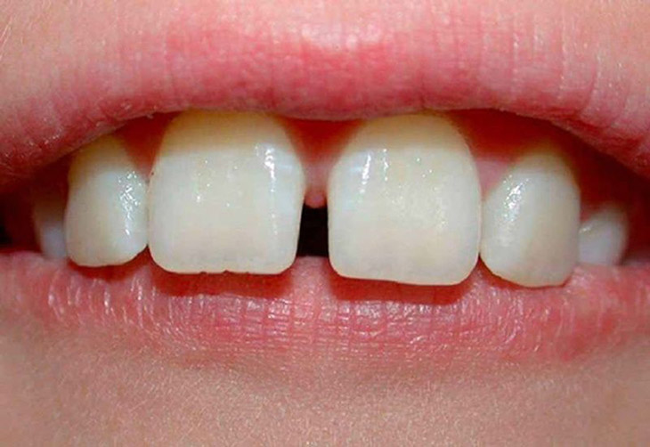 Việc niềng răng thưa giúp xử lý khuyết điểm, mang đến nụ cười tự tin