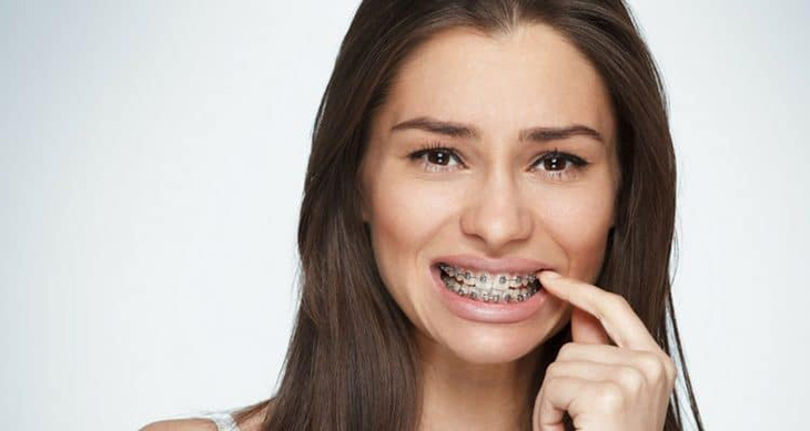 Niềng răng thưa là điều cần thiết với sức khỏe răng miệng