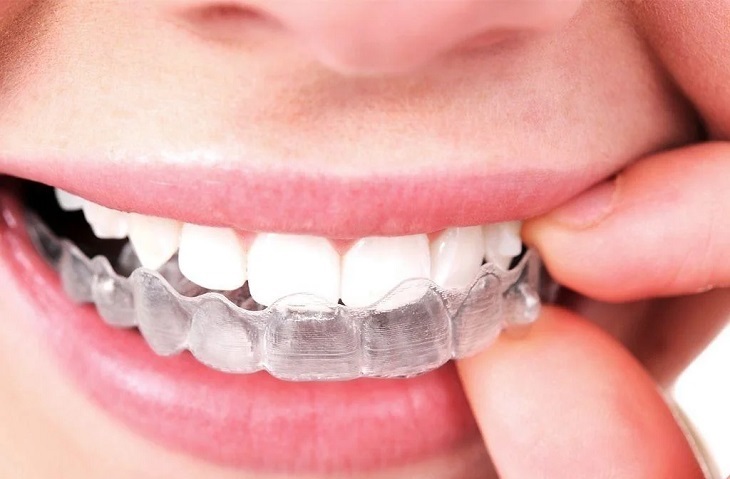 Niềng răng trong suốt có giá cao hơn so với những phương pháp niềng răng khác