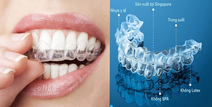 Niềng răng trong suốt mang đến rất nhiều lợi ích cho người sử dụng