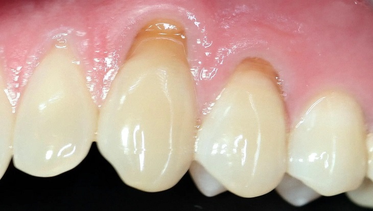 Tác hại của niềng răng dẫn đến tiêu chân răng