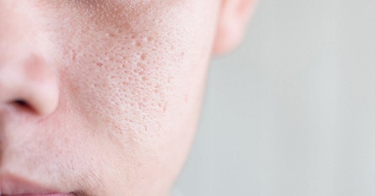 Lỗ chân lông to là một khuyết điểm trên gương mặt khiến nhiều người cảm thấy tự ti