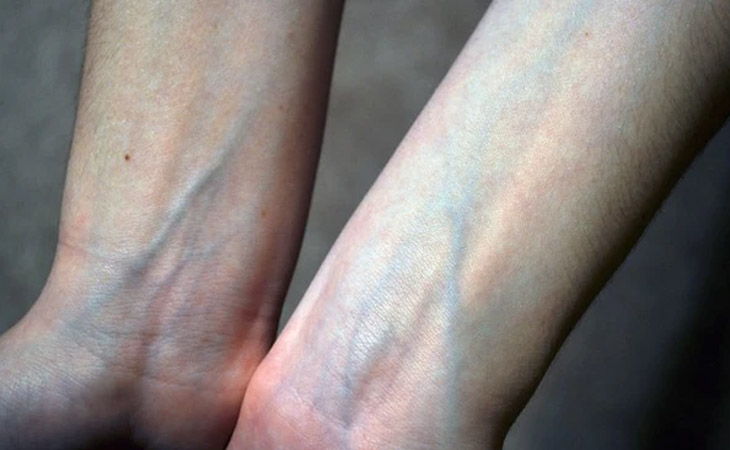 Quan sát màu của tĩnh mạch trên cổ tay