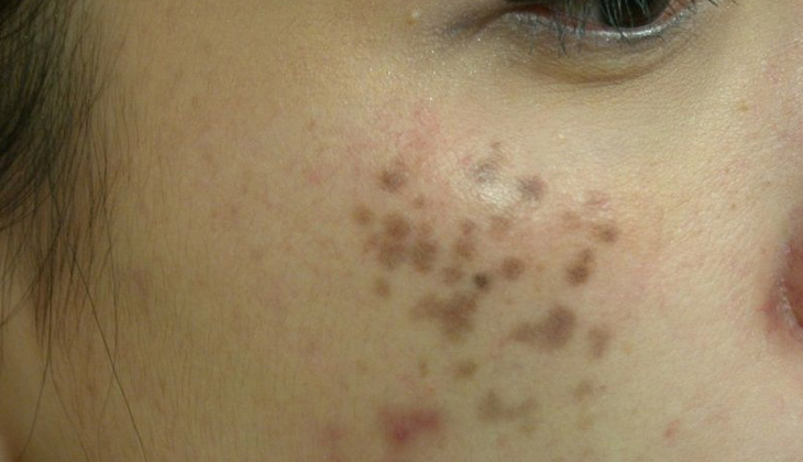 Bớt Hori (Hori Nevus) là bệnh tăng sắc tố da ở mặt
