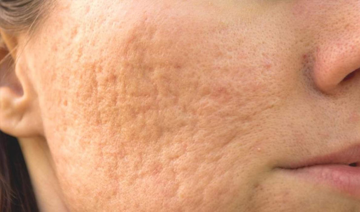 Sẹo rỗ là những vết lõm xuất hiện trên bề mặt da