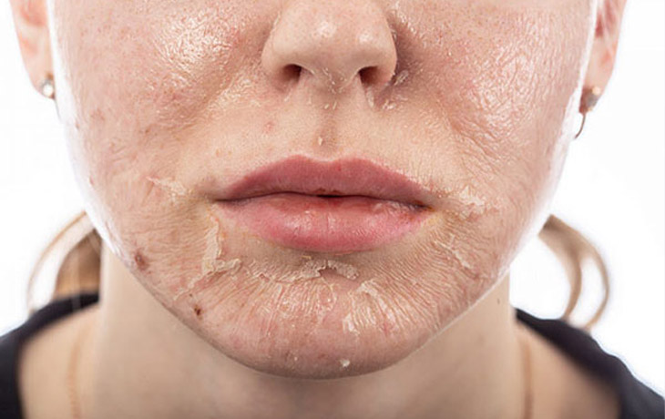 Trị nám da mặt bằng phương pháp peel da