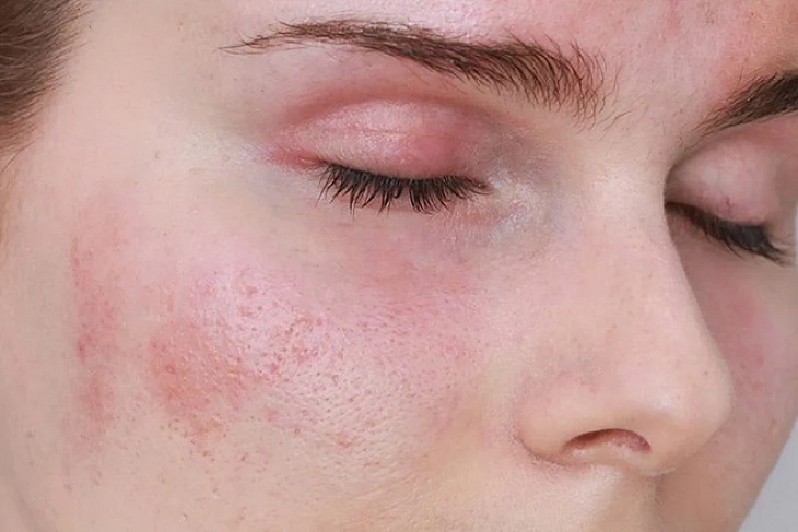 Nóng rát da là triệu chứng thường gặp sau khi điều trị nám bằng laser 